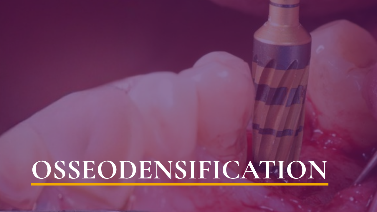 Osseodensification — An Innovative Drilling Technique
